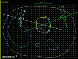 2D radiotherapy plan 