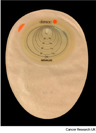 Photo showing the back of a colostomy bag 