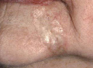 Photograph of morphoeic basal cell carcinoma