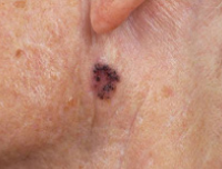 Photograph of pigmented basal cell cancer