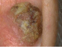 Photograph of squamous cell cancer