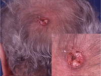 Photograph of squamous cell cancer on scalp 